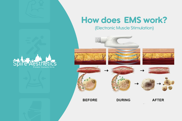 EMS treatment for post pregnancy weight loss treatment Bagshot