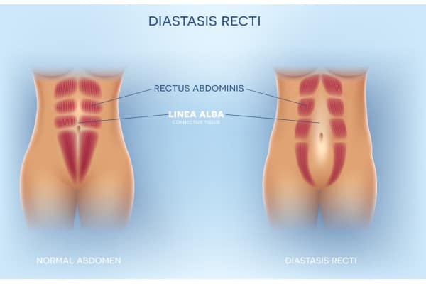 What Non-Surgical Options Are Available for Diastasis Recti Bagshot?