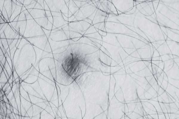 Dermatofibroma removal Bagshot made simple! Book in today!