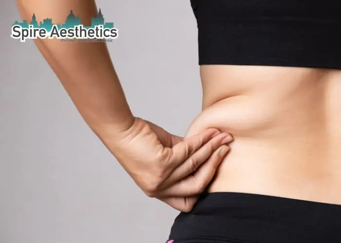 Image of woman pinching fat on their hips Bagshot. Fat Freezing treatment
