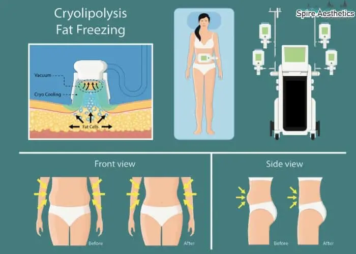 Fat freezing treatment Bagshot benefits for competitions to remove stubborn fat deposits.