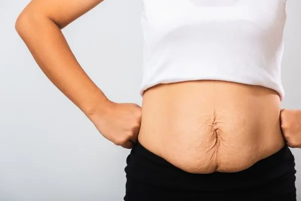 Image of a woman's stomach after weight loss with sagging skin following a gastric band Bagshot