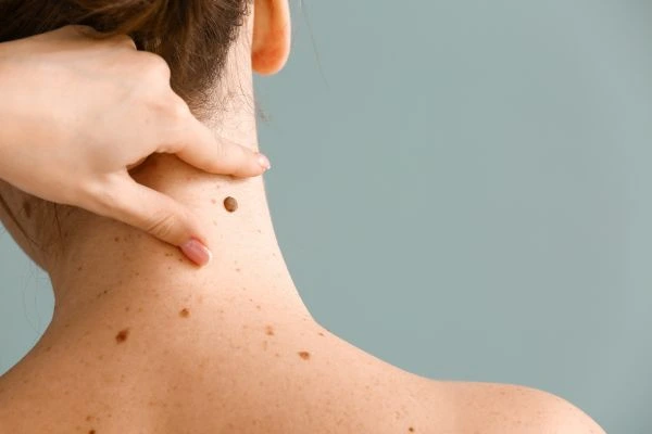 skin blemish removal Bagshot treatment