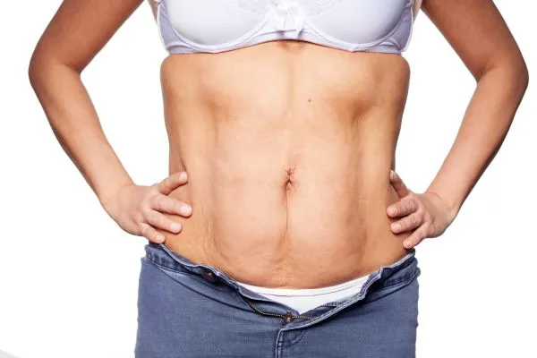 sagging skin on woman's stomach after weight loss injections Bagshot