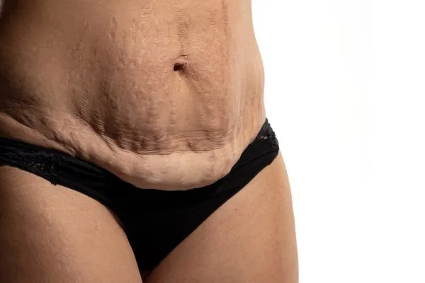 Image of womans stomach after weight loss injections Bagshot showing saggy skin