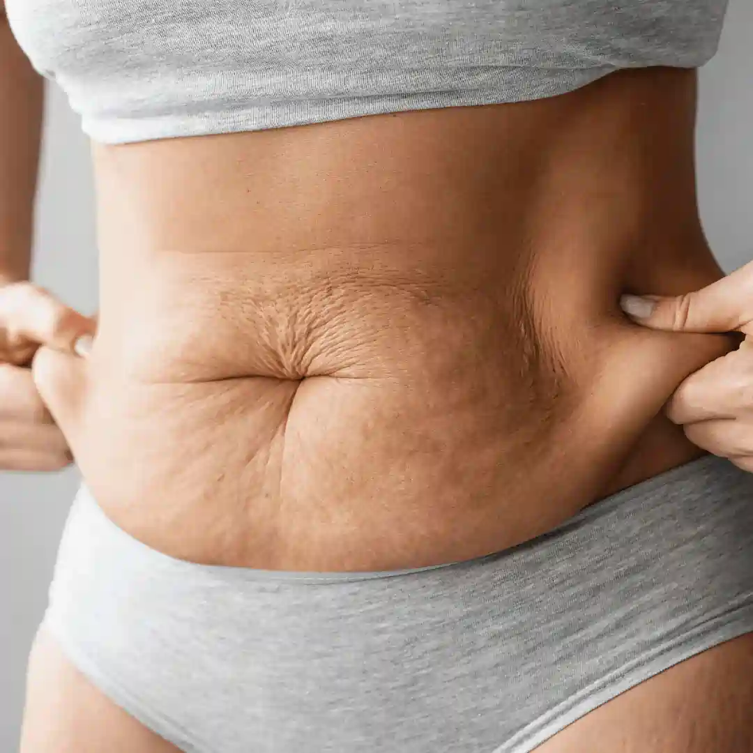 Is It Normal to Have Loose Skin After Pregnancy Bagshot?