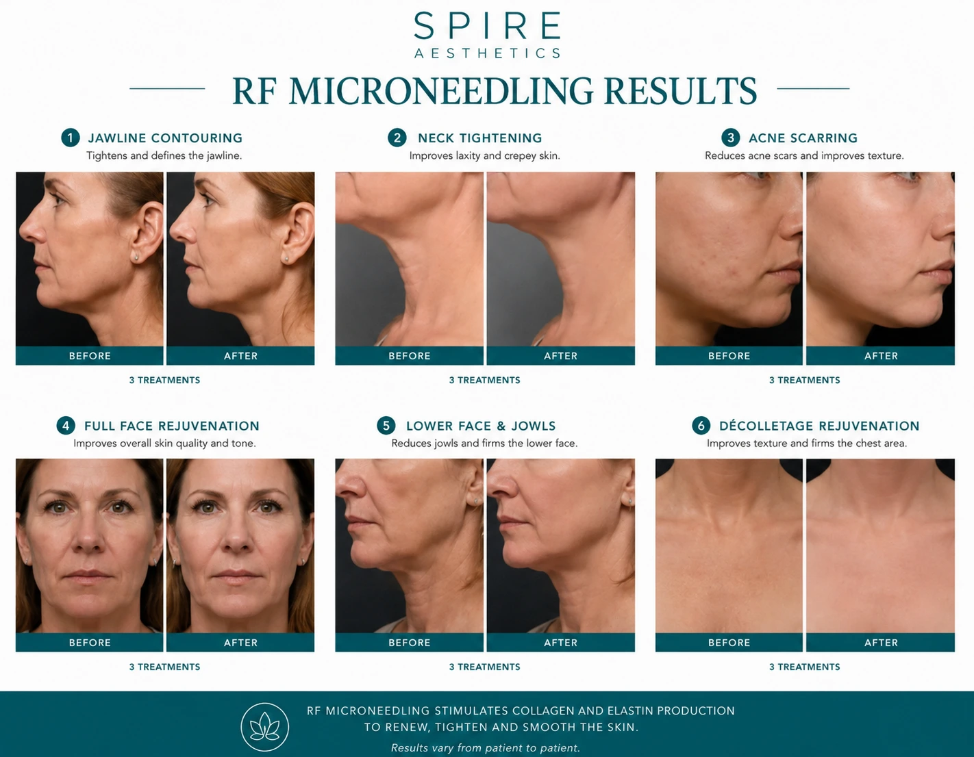RF Microneedling Skin tightening Bagshot results