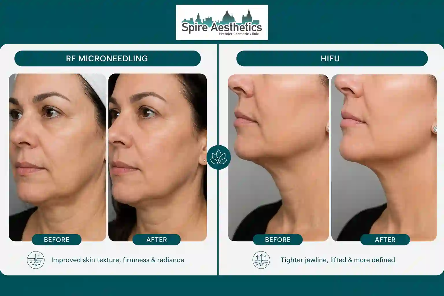 Can RF Microneedling and HIFU Be Combined Bagshot?