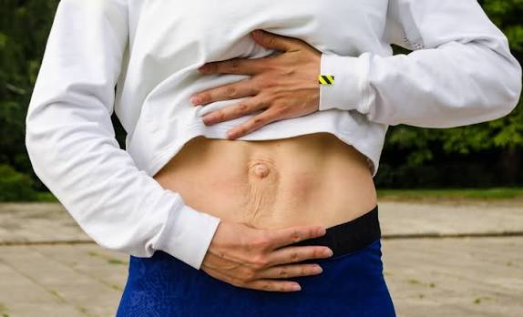 When Could Diastasis Recti Be the Missing Piece of the Puzzle Bagshot?